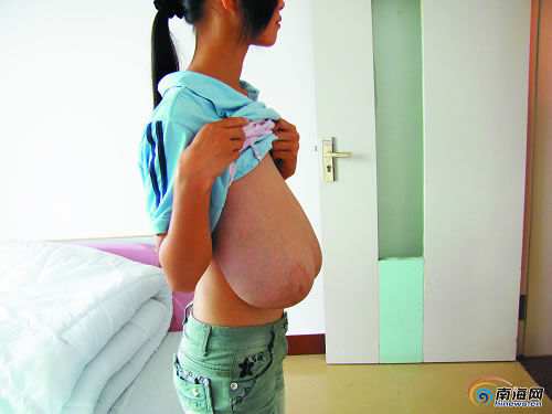 16岁少女患巨乳症双乳重16斤垂到肚脐